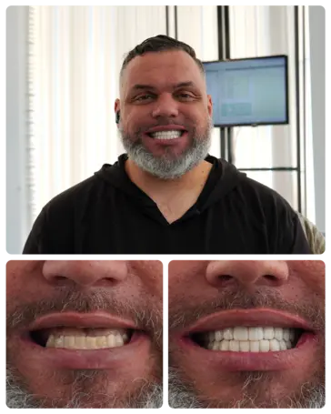 Full mouth Implants transformation — Angel